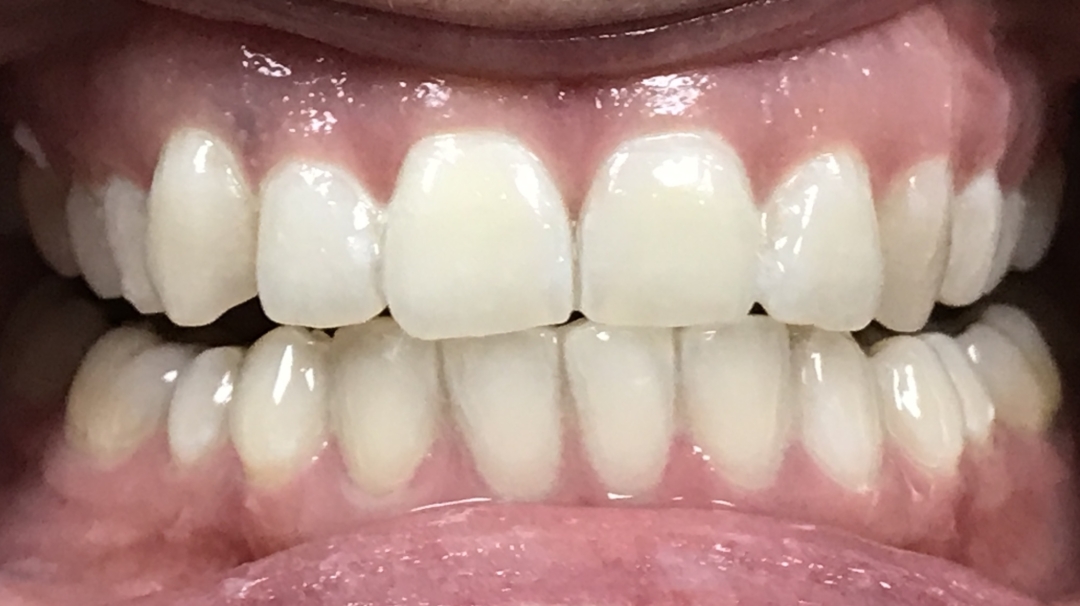 After image