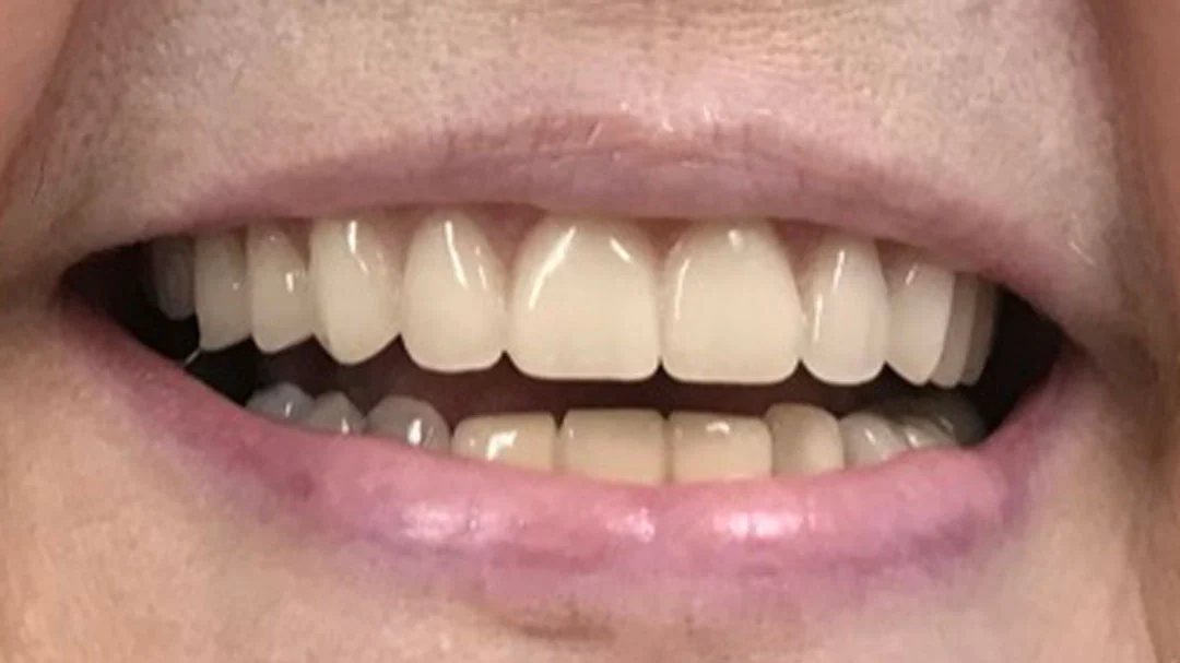 After image