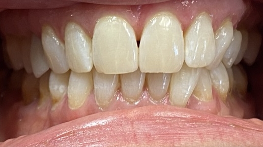 After image