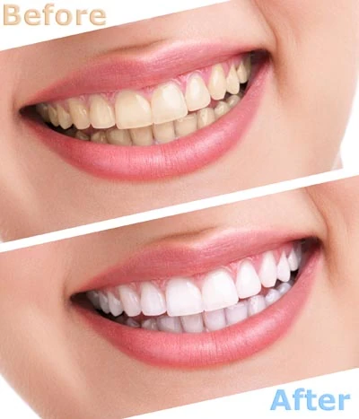 comparison of before and after teeth whitening at Park Ridge Smile Center