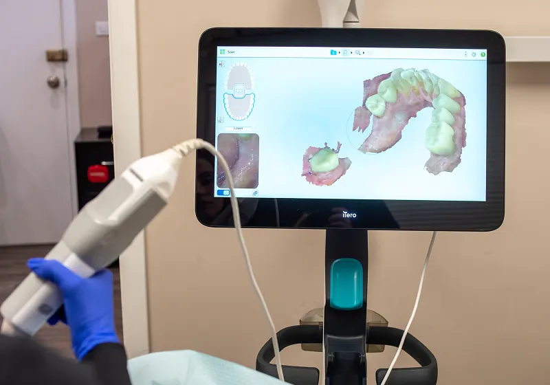 iTero scanner wand and 3D scan on monitor